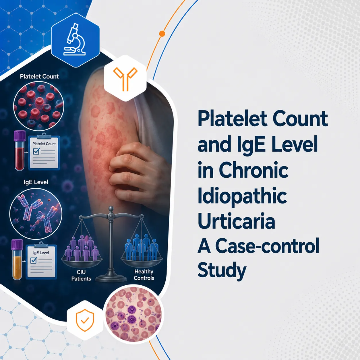 Platelet Count and IgE Level in Chronic Idiopathic Urticaria A Case-control Study
